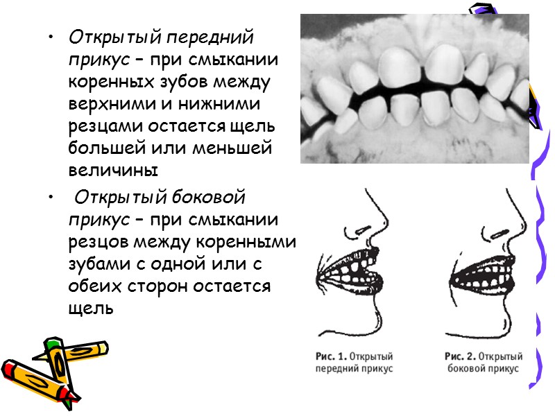 Открытый передний прикус – при смыкании коренных зубов между верхними и нижними резцами остается